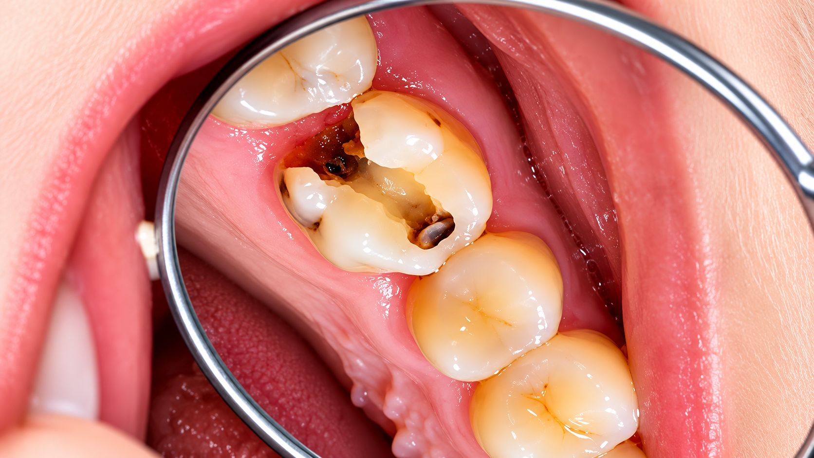 Tooth Pulp Infection