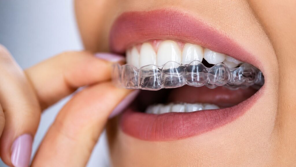 Teeth Straightening Treatment in Kanpur
