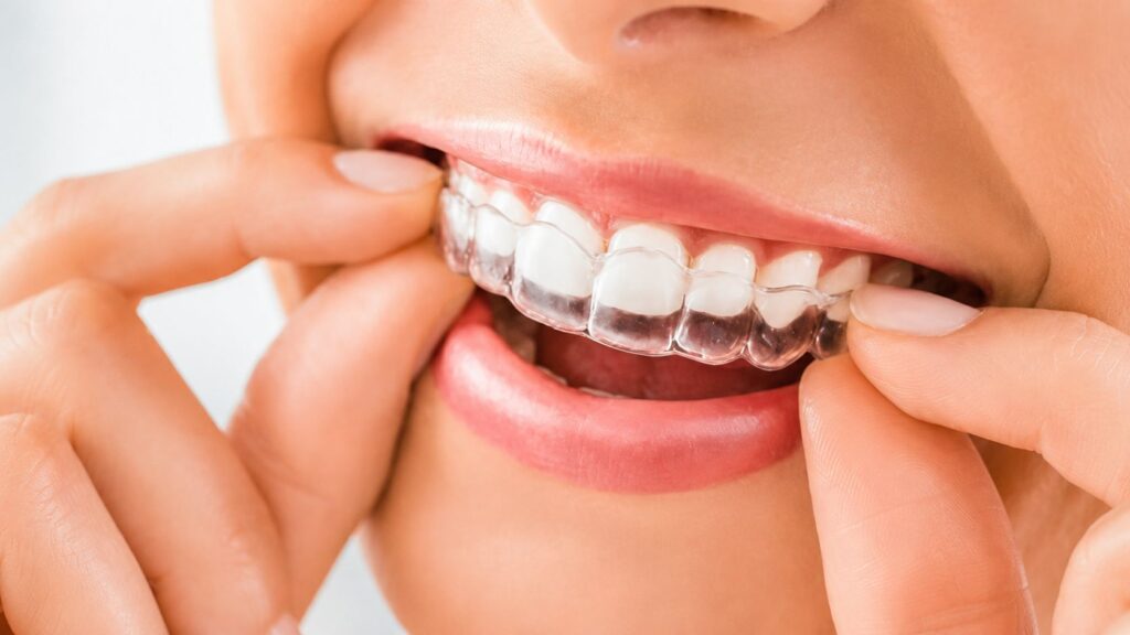 Teeth Alignment Treatment